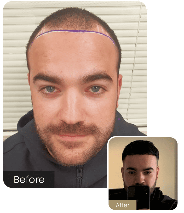 Hair transplant consultation