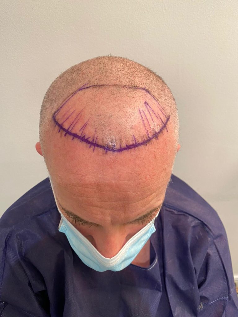 Donor extraction preparation